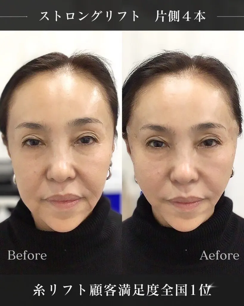 ストロングリフト