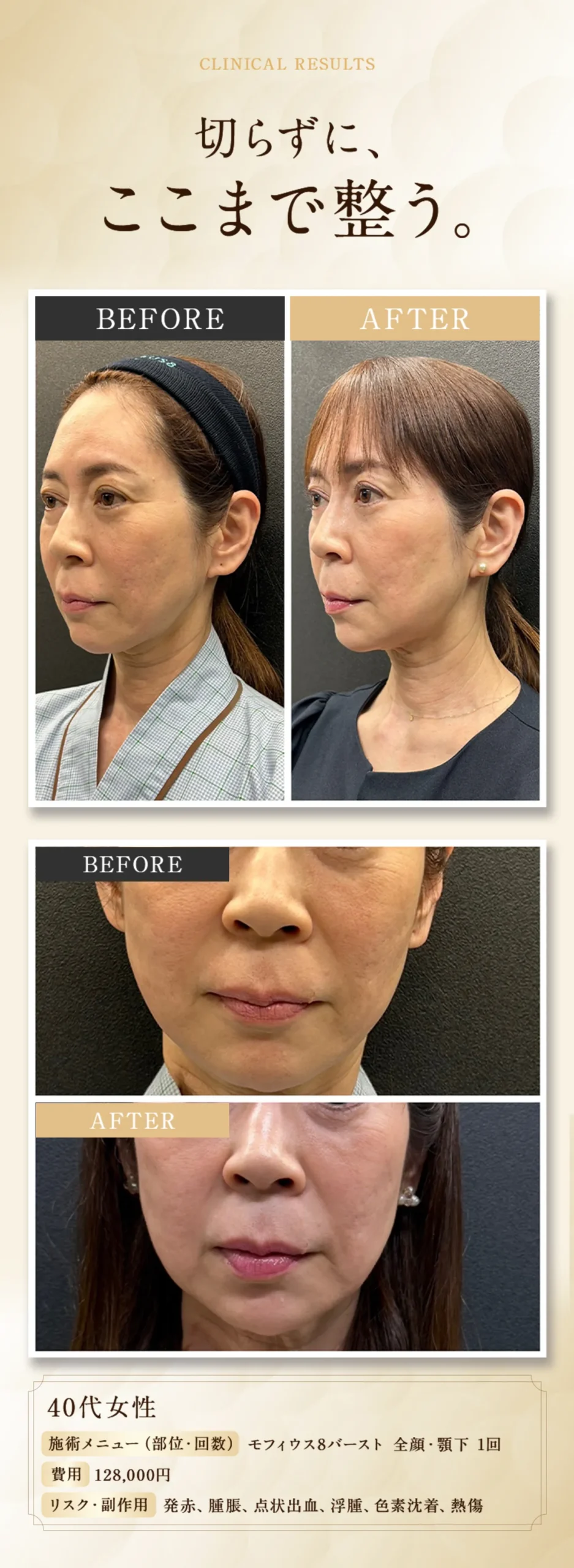 切らずに、ここまで整う。【40代女性】 施術メニュー(部位・回数): モフィウス8バースト 全顔・顎下 1回。費用：128,000円。 リスク・副作用：発赤、腫脹、点状出血、浮腫、色素沈着、熱傷