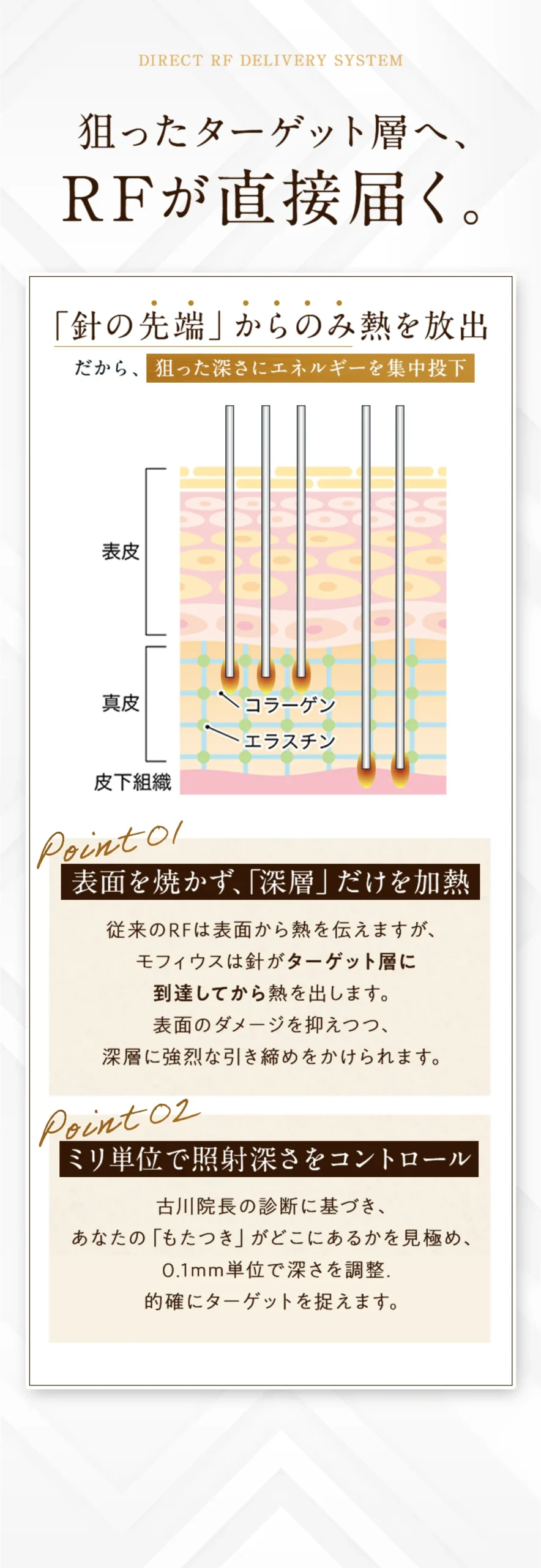 狙ったターゲット層へ、RFが直接届く。「針の先端」からのみ熱を放出だから、狙った深さにエネルギーを集中投下。ポイント1：表面を焼かず、「深層」だけを加熱。従来のRFは表面から熱を伝えますが、 モフィウスは針がターゲット層に 到達してから熱を出します。 表面のダメージを抑えつつ、深層に強烈な引き締めをかけられます。 ポイント2：ミリ単位で照射深さをコントロール。古川院長の診断に基づき、 あなたの「もたつき」がどこにあるかを見極め、 0.1mm単位で深さを調整. 的確にターゲットを捉えます。